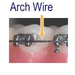 Understanding Your Braces, Dr. Blaine Langberg Orthodontics